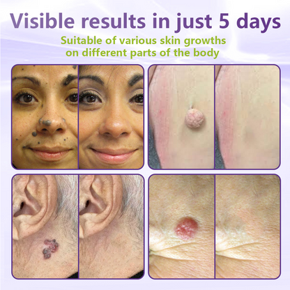 SOLUBLE MICRONEEDLE BOTANICAL SKIN TAG REMOVAL PATCH-ZDJ