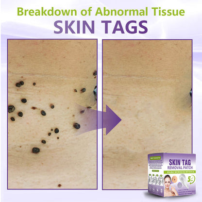 SOLUBLE MICRONEEDLE BOTANICAL SKIN TAG REMOVAL PATCH-ZDJ