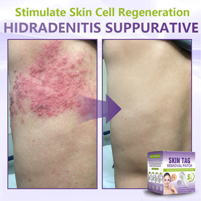 SOLUBLE MICRONEEDLE BOTANICAL SKIN TAG REMOVAL PATCH-ZDJ