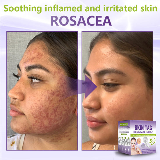SOLUBLE MICRONEEDLE BOTANICAL SKIN TAG REMOVAL PATCH-ZDJ