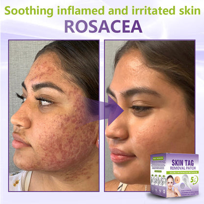 SOLUBLE MICRONEEDLE BOTANICAL SKIN TAG REMOVAL PATCH-ZDJ