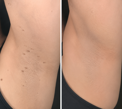 ✨2-in-1 Microneedle & Hydrocolloid Patch🍀| Removes Raised Moles, Acne, Flat Warts & Skin Tags | Helps Improve Wrinkles, Scars & Blemishes | Invisible Patches for Face & Body-ZDJ
