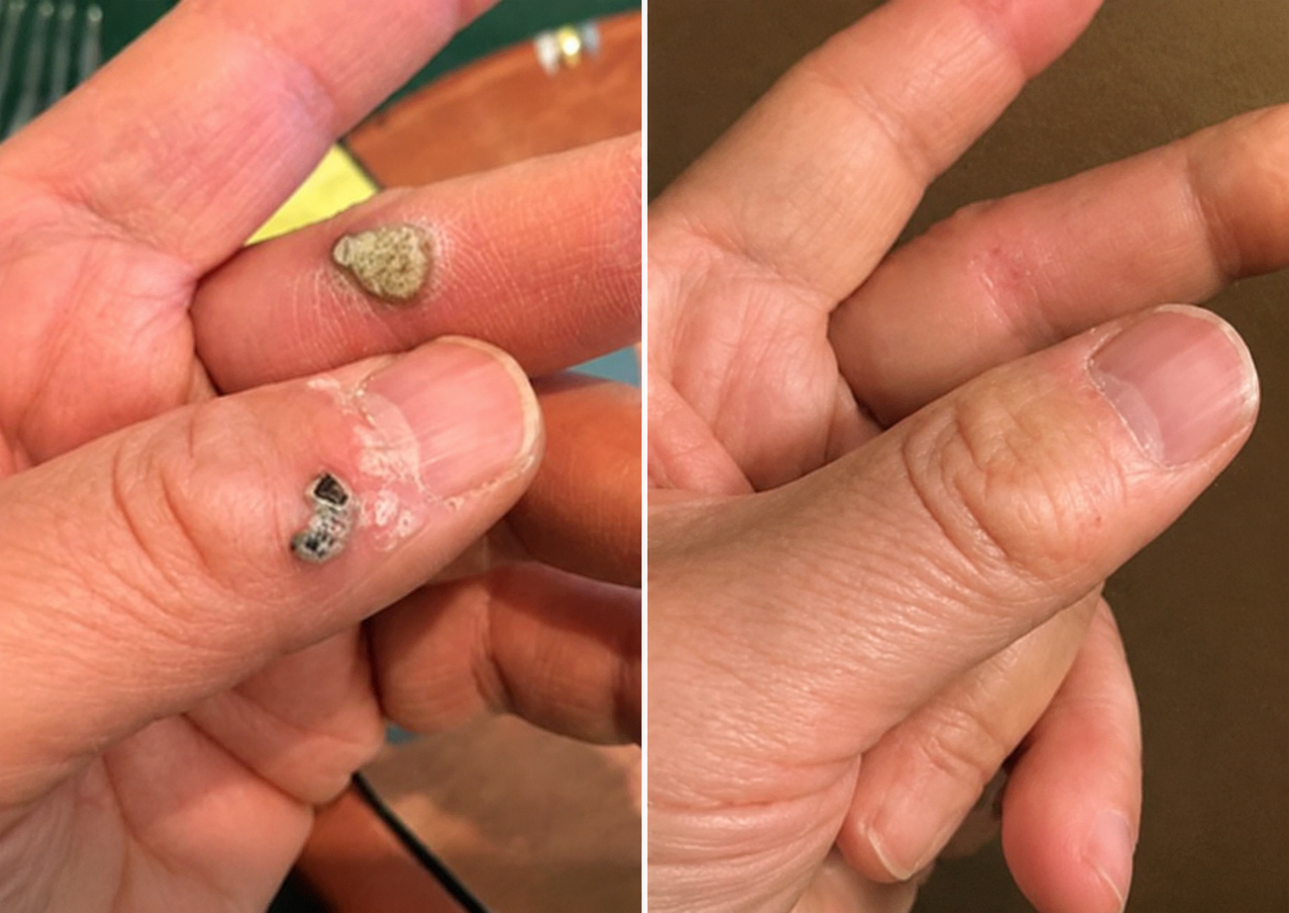 ✨2-in-1 Microneedle & Hydrocolloid Patch🍀| Removes Raised Moles, Acne, Flat Warts & Skin Tags | Helps Improve Wrinkles, Scars & Blemishes | Invisible Patches for Face & Body-CU
