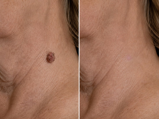 Microneedle hydrocolloid patch image 21