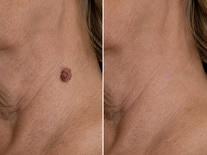 Microneedle hydrocolloid patch image 21